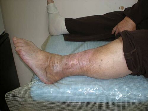 ulcus-zatvoren-posle-3meseca