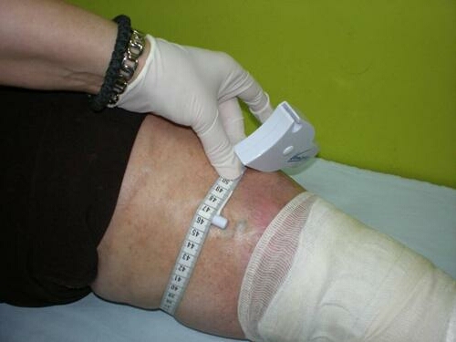 lečenje limfedema gornjih i donjih ekstremiteta