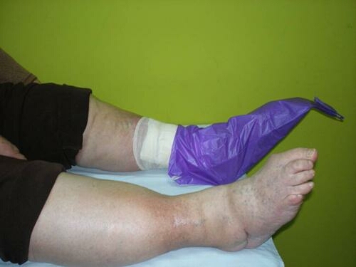 sprovođenje kompletnog anticelulit programa